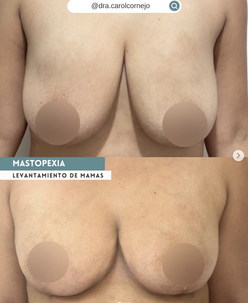 Levantamiento mamario resultado